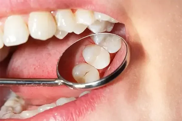 Tooth-Coloured Fillings-final