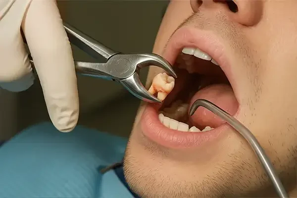 Tooth Extraction-final